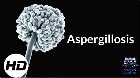 Aspergillosis Everything You Need To Know Youtube