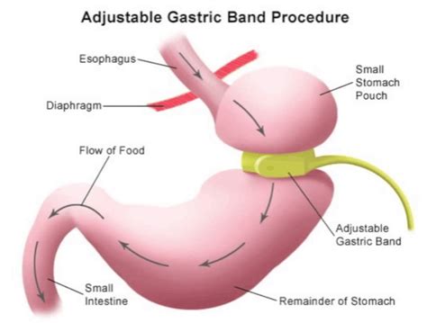 10 Best Clinics For Gastric Band Surgery In Egypt 2023 Prices