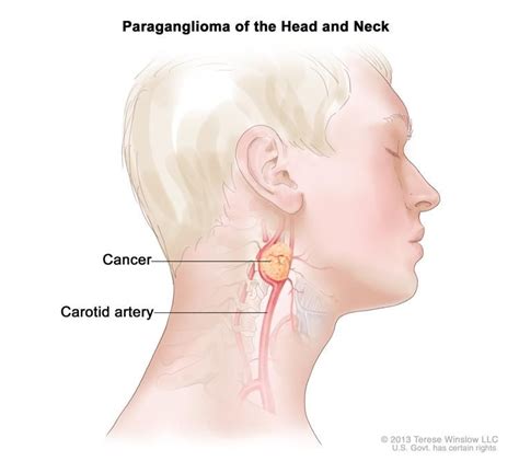 The number of spine cancer patients is increasing in the country in the recent years, according to doctors. Lump On Neck Cancer Symptoms - Cancer News Update