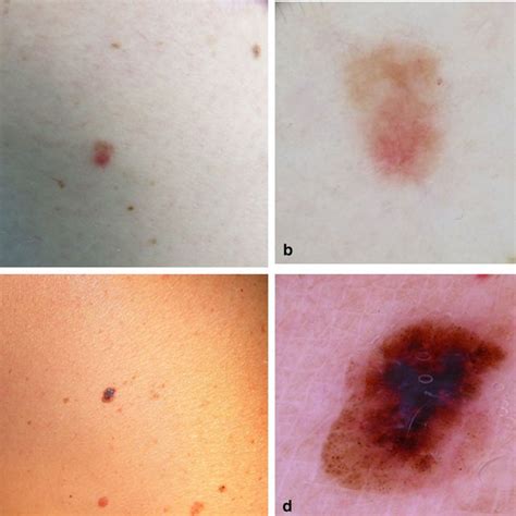 A Clinical And B Dermoscopic Images Of A Superficial Spreading Melanoma