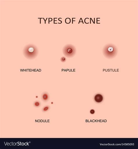 Types Of Acne And Pimples Royalty Free Vector Image
