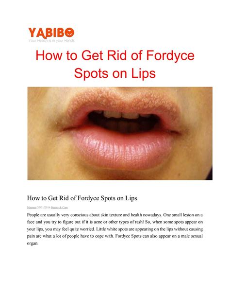 How To Get Rid Of Fordyce Spots On Lips By Ankithaanu Issuu