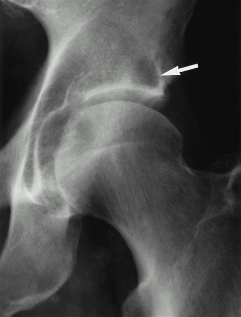 Osteoarthritis A Ap Radiograph Of The Left Hip Shows Early
