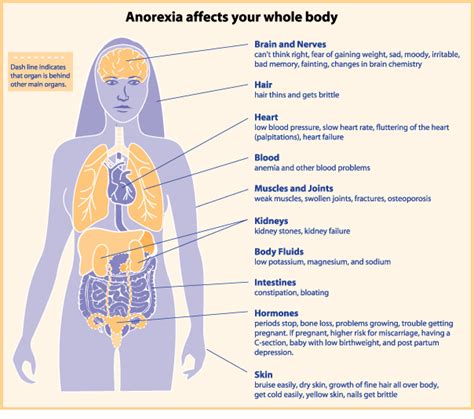 Anorexia Nervosa Physiopedia