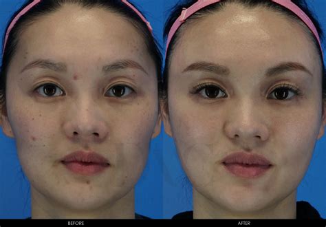 Acne And Acne Scar Improvement 3 Dmc Skin Clinic