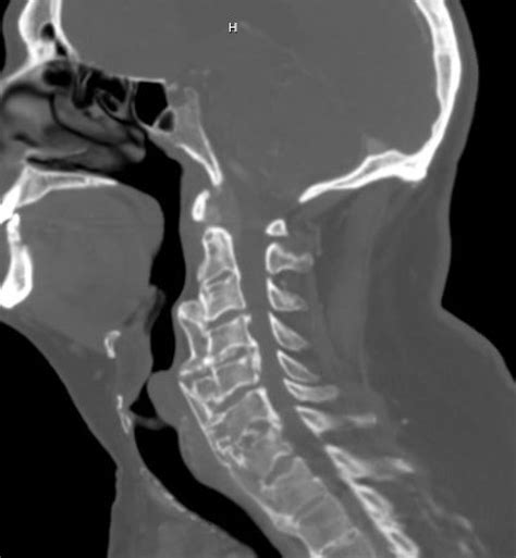 Anterior Cervical Osteophytectomy For Treatment Of Dysphagia