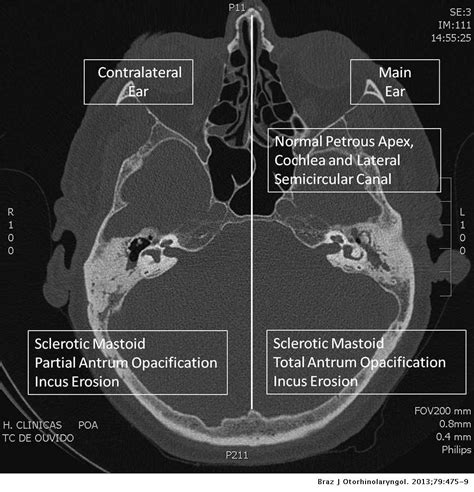Tomographic Evaluation Of The Contralateral Ear In Patients With Severe