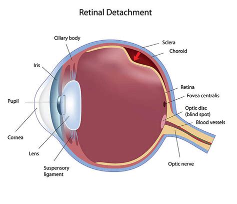 Retina Orange County Retinal Detachment Orange Harvard Eye