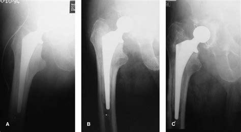 A Hip Arthroplasty Using Boneloc B 1 Year Postoperatively Type Ia