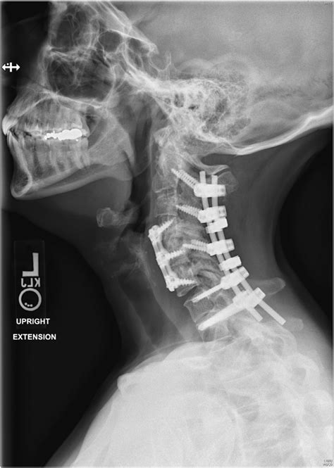 Post Operative Cervical Spine X Ray Demonstrating An Anterior C4 6