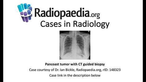 Pancoast Tumor With Ct Guided Biopsy Cases In