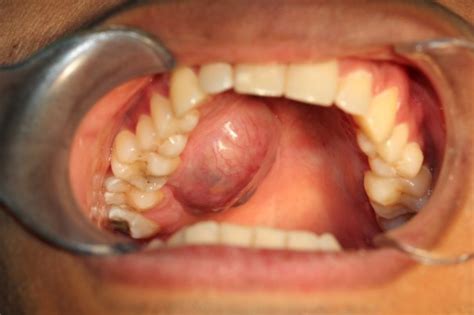 Oral Diseases And Cancer Medical Orofacial Surgery