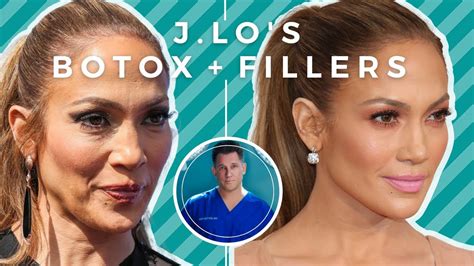 Jennifer Lopezs Botox And Filler Plastic Surgery A Plastic Surgeon