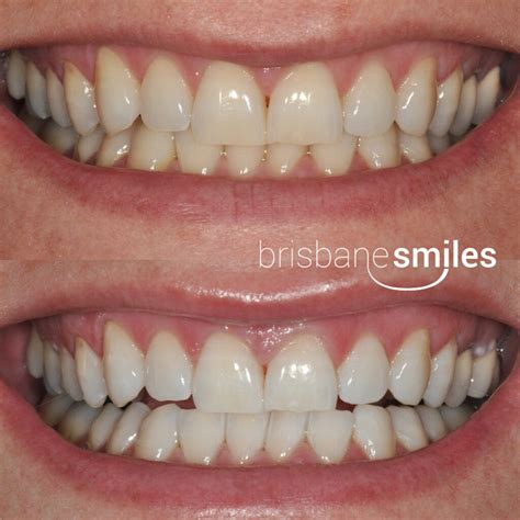 Teeth Whitening Brisbane Zoom Whitening Brisbane Smiles
