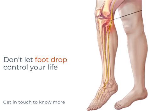 Foot Drop Treatment Dubai Foot Lifting Problem Dubai Foot Surgeon