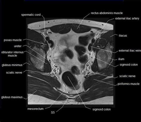 A variably thick muscular membrane called a diaphragm coccygeus and levator ani muscles (iliococcygeus, puborectalis the muscles are attached along the inner walls of the true pelvis to a condensed area of the obturator fascia known as the tendinous arch of levator ani muscle. mri hip anatomy - www.unidadortopedia.com PBX: 6923370 ...