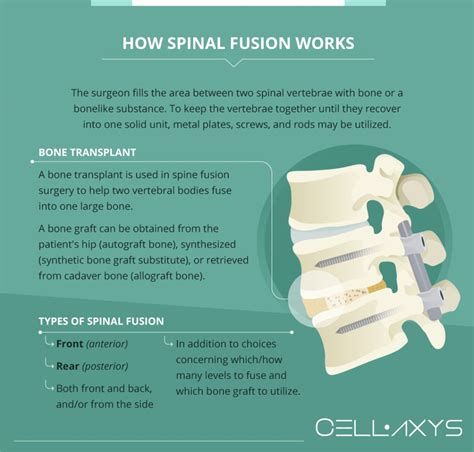 Spinal Fusion Surgery Cellaxys