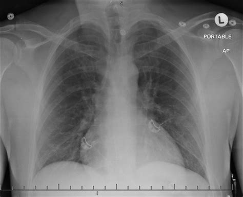 Chest X Ray Demonstrating Absence Of Implanted Loop Recorder Download