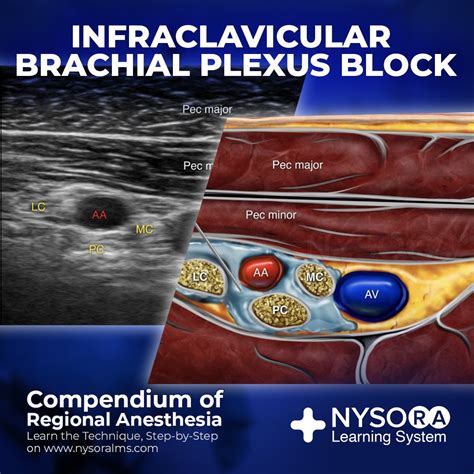 Infraclavicular Block