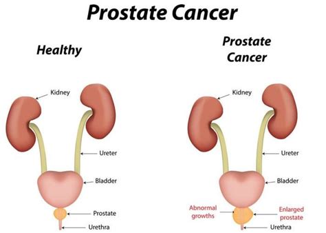 What Is Prostate Cancer 9 Signs And Symptoms 99 Health Ideas