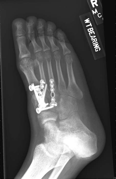 Surgical Treatment Of Lisfranc Injury With Plantar Plate Approach The