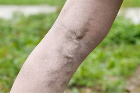 What Is Phlebitis Treatment And Symptoms For Thrombophlebitis