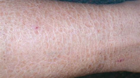 It will further irritate the itching skin. Itching: Pictures, Causes, Diagnosis, Home Remedies & More