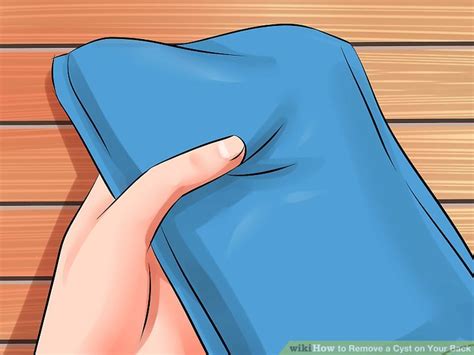3 Ways To Remove A Cyst On Your Back WikiHow