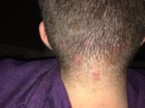 White Bumps On Head Scalp