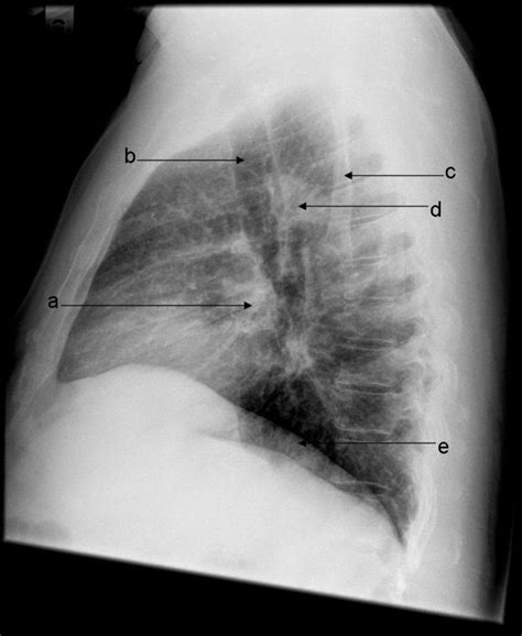 Lateral Radiograph Of The Chest The Bmj
