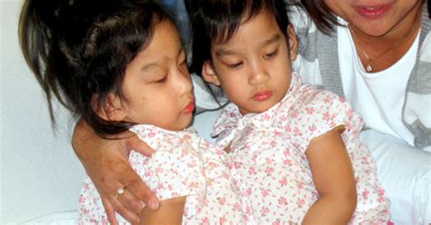 Conjoined twins separated in Calif.: How are they doing ...