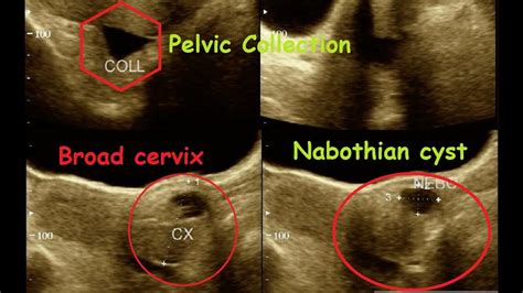 Nabothian Cyst Usg Abdomen Scan Ultrasonography Report Amader