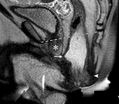 Mri Of The Male Pelvic Floor Radiographics