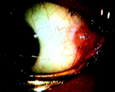 Primary Monophasic Synovial Sarcoma Of The Conjunctiva
