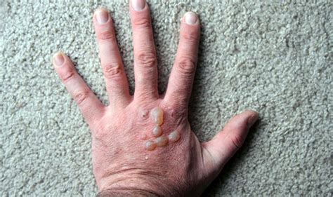 Type 2 Diabetes Skin Blisters Is An Early Symptom Of The Condition