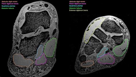 Exploration Of The Deep Foot Muscles At Ultra High Field • National