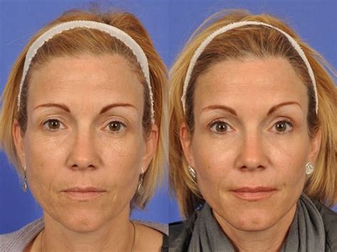 Non Surgical Facelifts For Women Over 50 Non Surgical Procedures Before