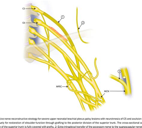 Figure 6 From Neonatal Brachial Plexus Palsy With Neurotmesis Of C5 And