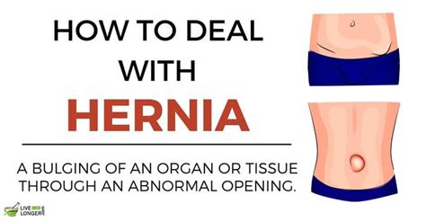 10 Home Remedies For Hernia That Ease The Discomfort Hernia Symptoms