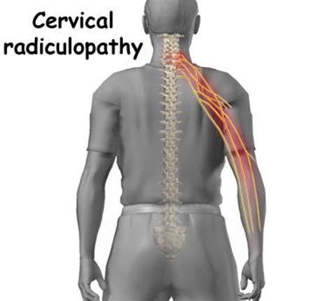 Cervical Radiculopathy Arm Pain