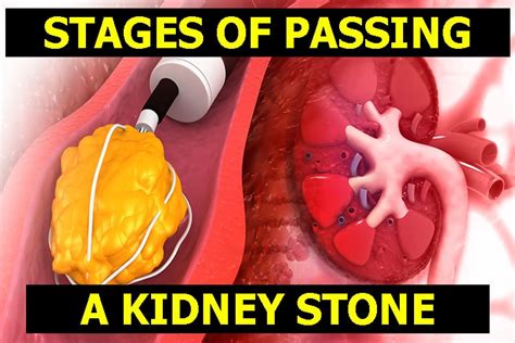 The 4 Stages Of Passing A Kidney Stone And Recognizing Early Signs