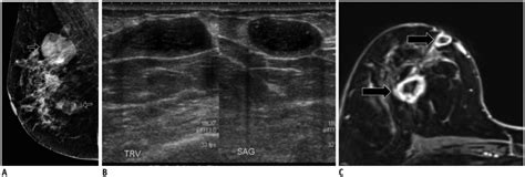 Imaging Features Of Inflammatory Breast Disorders A Pictorial Essay