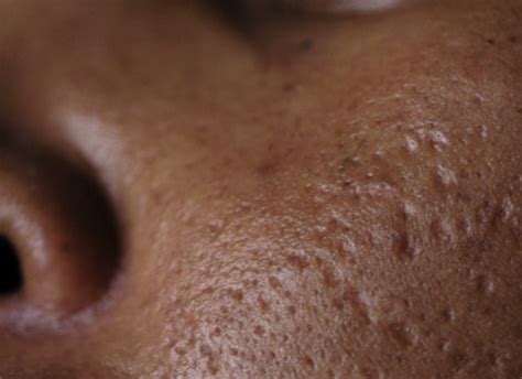 6 Types Of Acne And Pimple Scars And Its Treatments