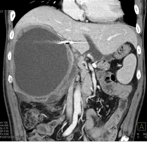 Hepatic Abscess Liver Case Studies Ctisus Ct Scanning