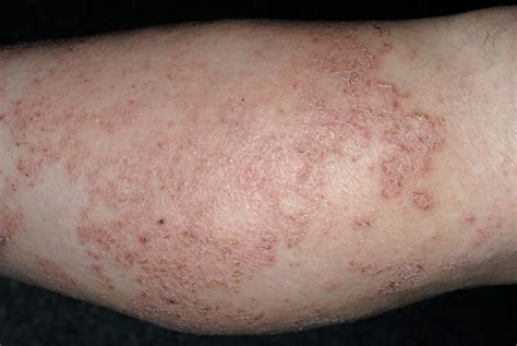 Increased Frequency Of Eosinophilia Examined With Dupilumab In Patients With Atopic Dermatitis