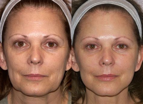 Botox For Your Lower Face And Neck