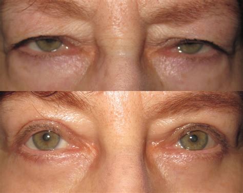 Denver Eyelid Surgery Blepharoplasty Denver Eyebag Treatment