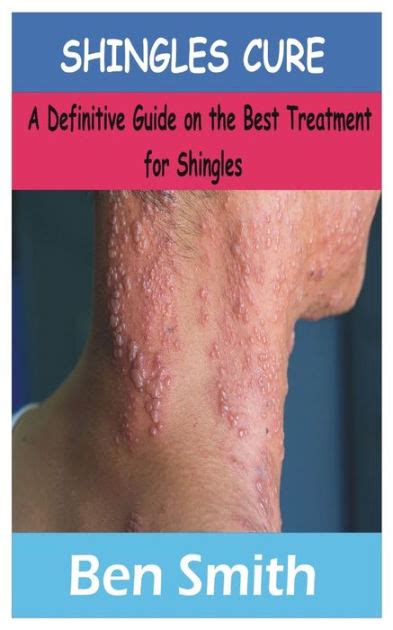 Shingles Cure A Definitive Guide On The Best Treatment For Shingles By