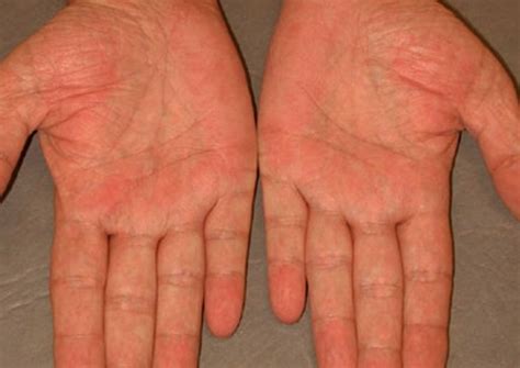 👉 Palmar Erythema Pictures Causes Treatment December 2021