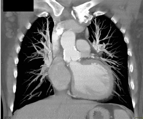 Calcification Of The Ascending Aorta Without Dissection Cardiac Case